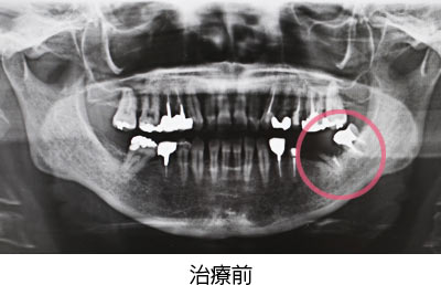 自家歯牙移植