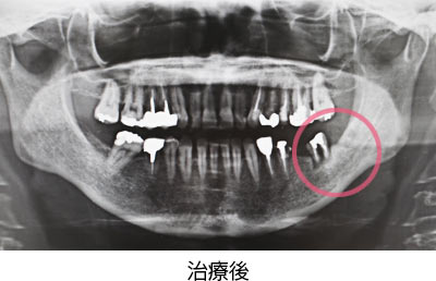 自家歯牙移植